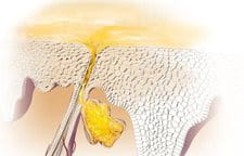 Znázornenie seborey.