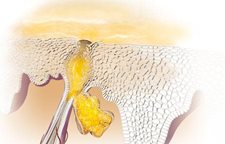 Znázornenie hyperkeratózy.