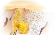 Znázornenie mikrobiálnej kolonizácie