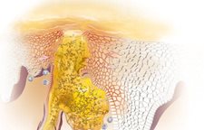 Znázornenie zápalu