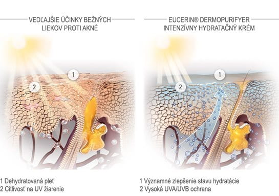 Obrázok vedľajších účinkov bežných liekov proti akné