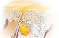 Znázornenie seborey