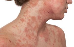 Žena s atopickou dermatitídou na hornej časti hrudníka a spodnej časti tváre
