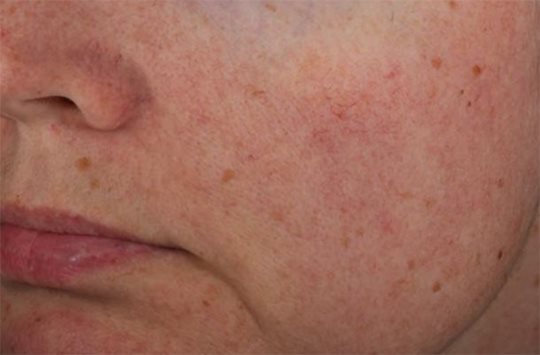 Fotografie výsledkov in vivo štúdie účinnosti Eucerin AntiREDNESS Upokojujúceho denného krému